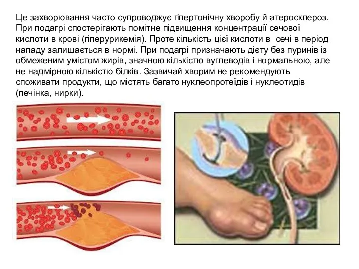 Це захворювання часто супроводжує гіпертонічну хворобу й атеросклероз. При подагрі спостерігають