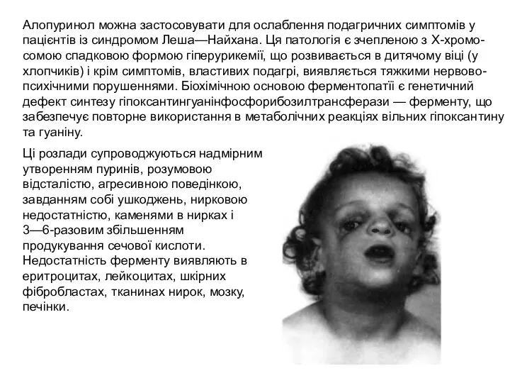 Алопуринол можна застосовувати для ослаблення подагричних симптомів у пацієнтів із синдромом