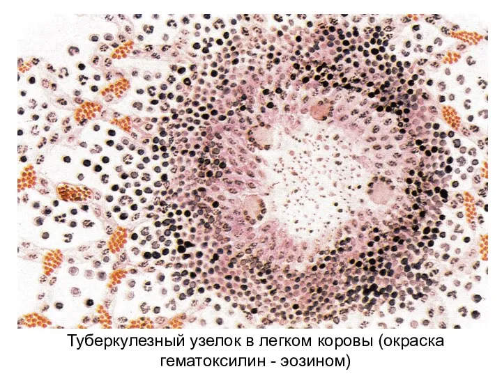 Туберкулезный узелок в легком коровы (окраска гематоксилин - эозином)