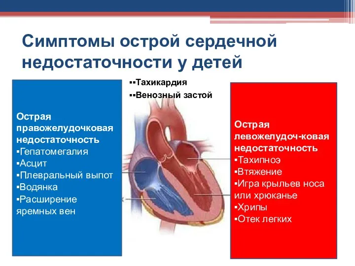 Симптомы острой сердечной недостаточности у детей ▪▪Тахикардия ▪▪Венозный застой Острая левожелудоч-ковая