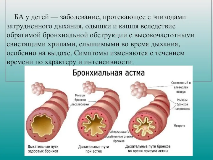 БА у детей — заболевание, протекающее с эпизодами затрудненного дыхания, одышки