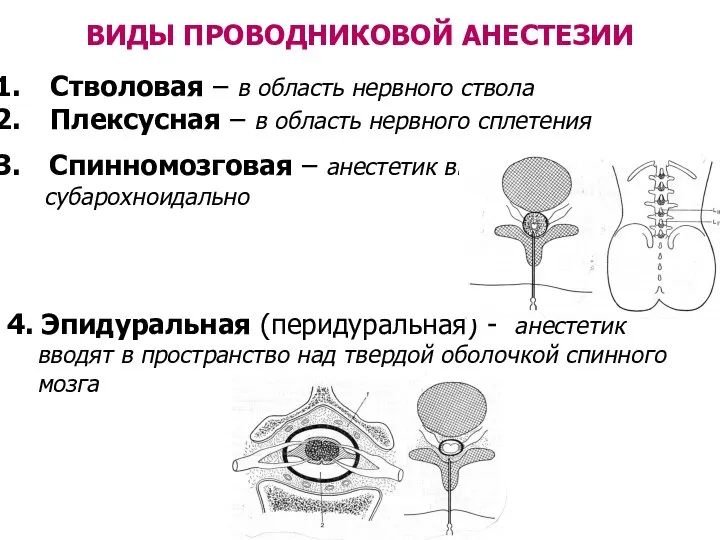 Спинномозговая – анестетик вводят субарохноидально 4. Эпидуральная (перидуральная) - анестетик вводят