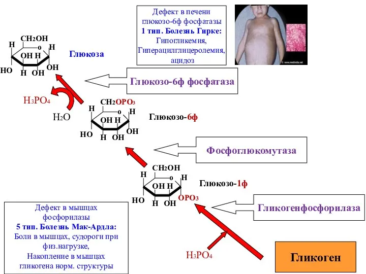 Гликоген Гликогенфосфорилаза Глюкоза Глюкозо-6ф Глюкозо-1ф Н3РО4 Фосфоглюкомутаза Глюкозо-6ф фосфатаза Дефект в