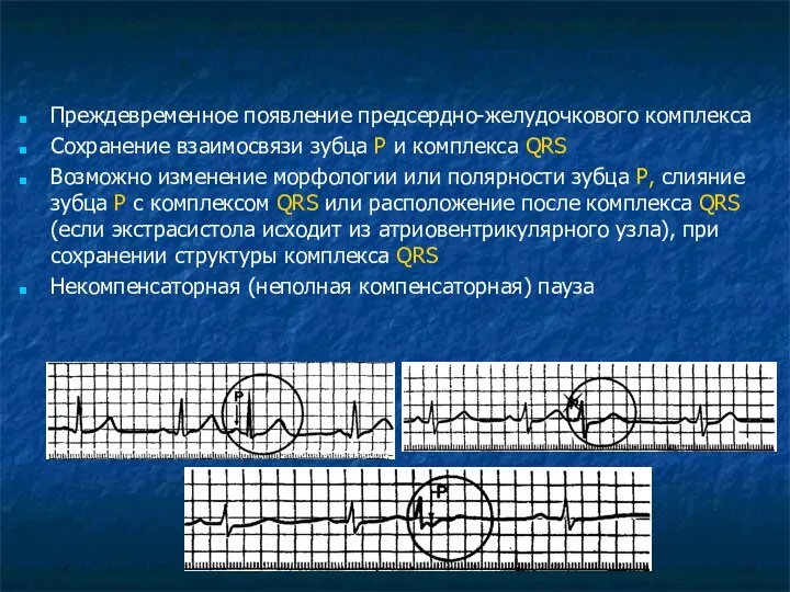 «Наджелудочковые» экстрасистолы Преждевременное появление предсердно-желудочкового комплекса Сохранение взаимосвязи зубца Р и