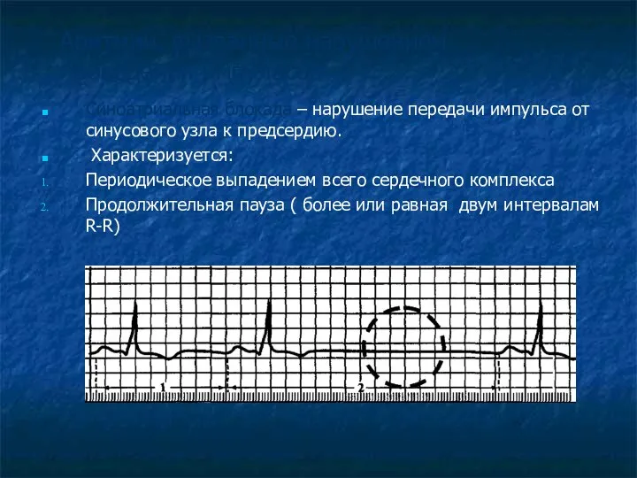 Аритмии, вызванные нарушением проведения импульсов Синоатриальная блокада – нарушение передачи импульса