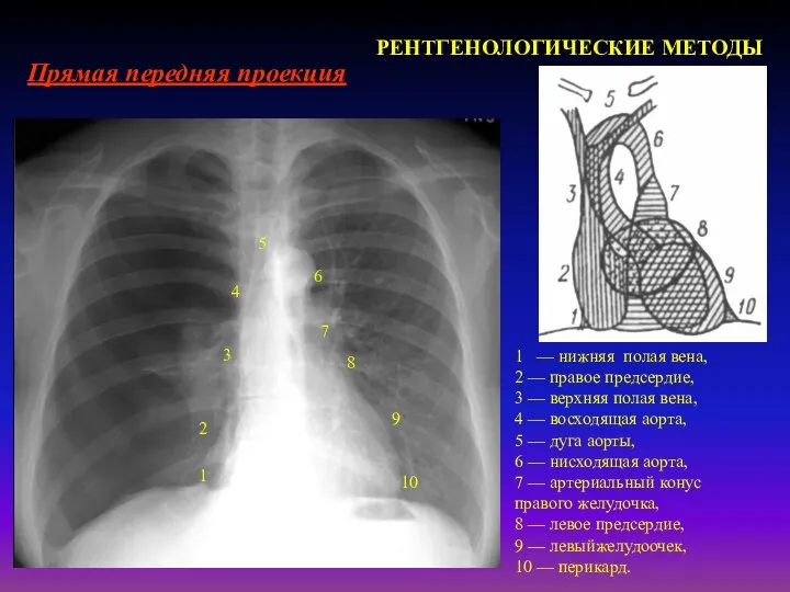 Лучевая диагностика заболеваний сердечно-сосудистой системы РЕНТГЕНОЛОГИЧЕСКИЕ МЕТОДЫ Прямая передняя проекция 1
