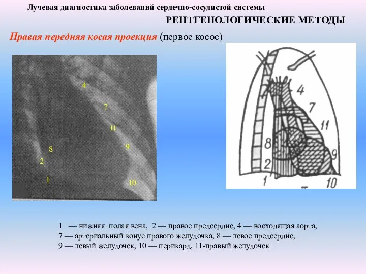 Лучевая диагностика заболеваний сердечно-сосудистой системы РЕНТГЕНОЛОГИЧЕСКИЕ МЕТОДЫ Правая передняя косая проекция