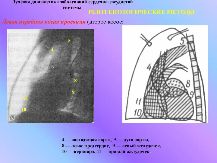 Лучевая диагностика заболеваний сердечно-сосудистой системы РЕНТГЕНОЛОГИЧЕСКИЕ МЕТОДЫ Левая передняя косая проекция