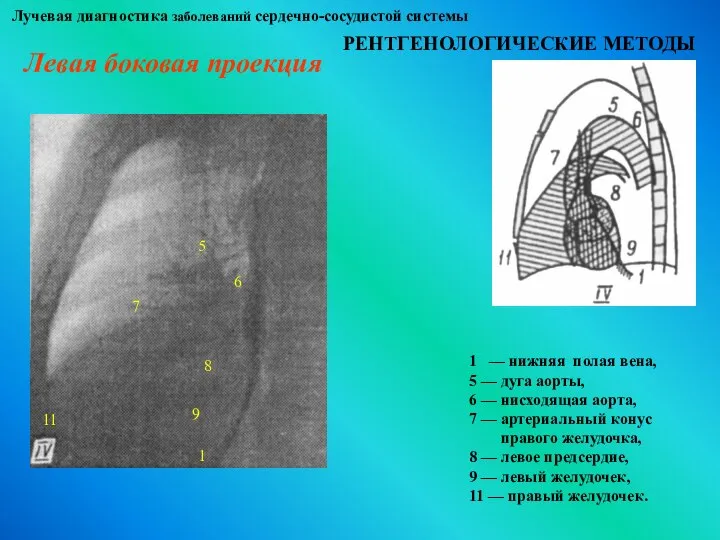 Лучевая диагностика заболеваний сердечно-сосудистой системы РЕНТГЕНОЛОГИЧЕСКИЕ МЕТОДЫ Левая боковая проекция 1