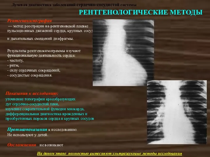 Лучевая диагностика заболеваний сердечно-сосудистой системы РЕНТГЕНОЛОГИЧЕСКИЕ МЕТОДЫ Рентгенокимография — метод реестрации