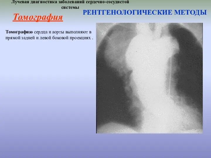 Лучевая диагностика заболеваний сердечно-сосудистой системы РЕНТГЕНОЛОГИЧЕСКИЕ МЕТОДЫ Томографию сердца и аорты