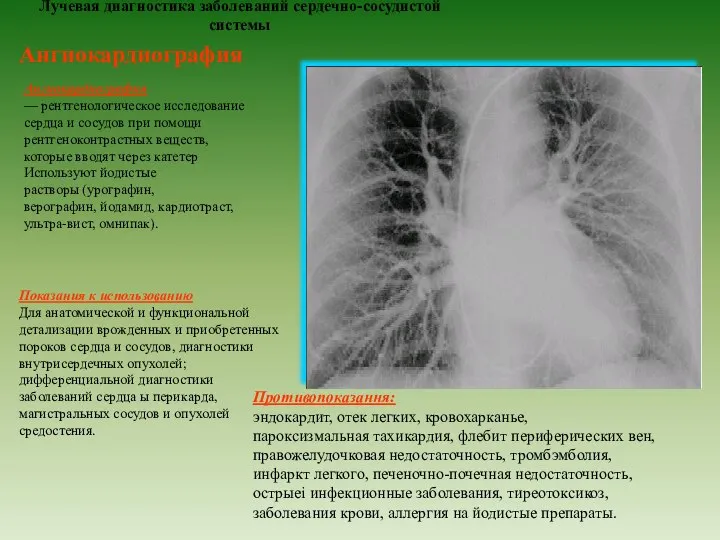 Лучевая диагностика заболеваний сердечно-сосудистой системы Ангиокардиография Ангиокардиография — рентгенологическое исследование сердца