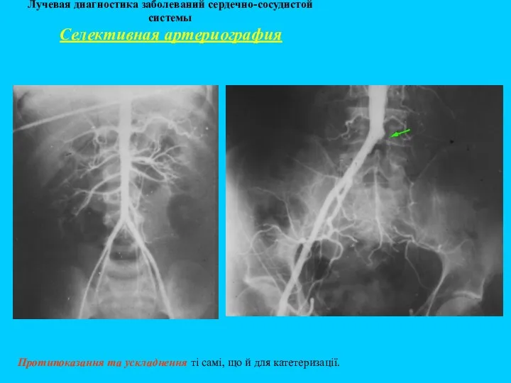 Лучевая диагностика заболеваний сердечно-сосудистой системы Протипоказання та ускладнення ті самі, що й для катетеризації. Селективная артериография