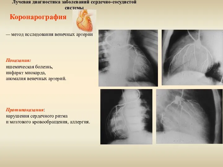 Лучевая диагностика заболеваний сердечно-сосудистой системы Коронарография — метод исследования венечных артерий