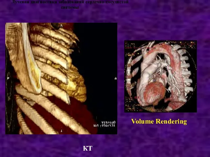 Лучевая диагностика заболеваний сердечно-сосудистой системы Volume Rendering КТ