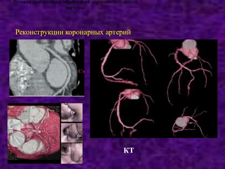 Лучевая диагностика заболеваний сердечно-сосудистой системы Реконструкции коронарных артерий КТ