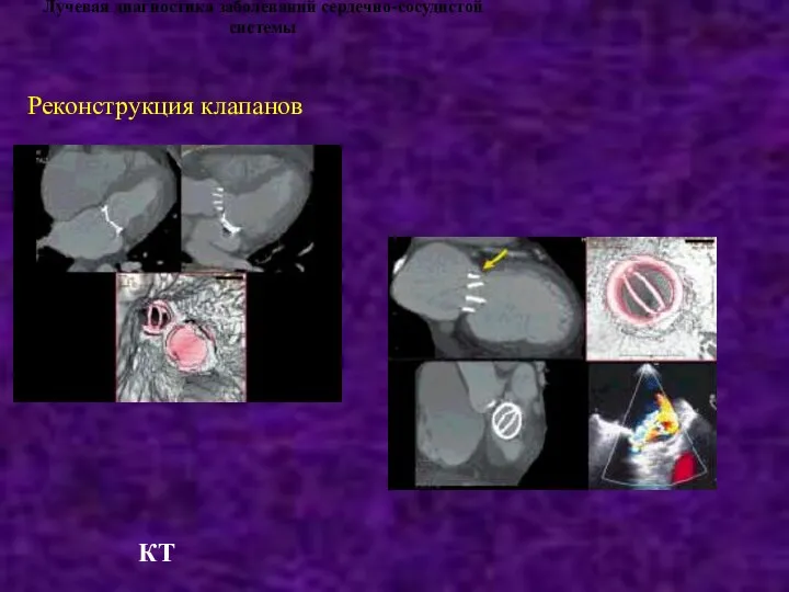 Лучевая диагностика заболеваний сердечно-сосудистой системы Реконструкция клапанов КТ