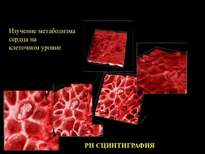 Лучевая диагностика заболеваний сердечно-сосудистой системы РН СЦИНТИГРАФИЯ Изучение метаболизма сердца на клеточном уровне