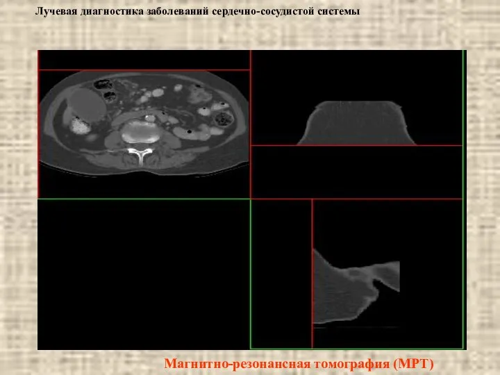 Лучевая диагностика заболеваний сердечно-сосудистой системы Магнитно-резонансная томография (МРТ)