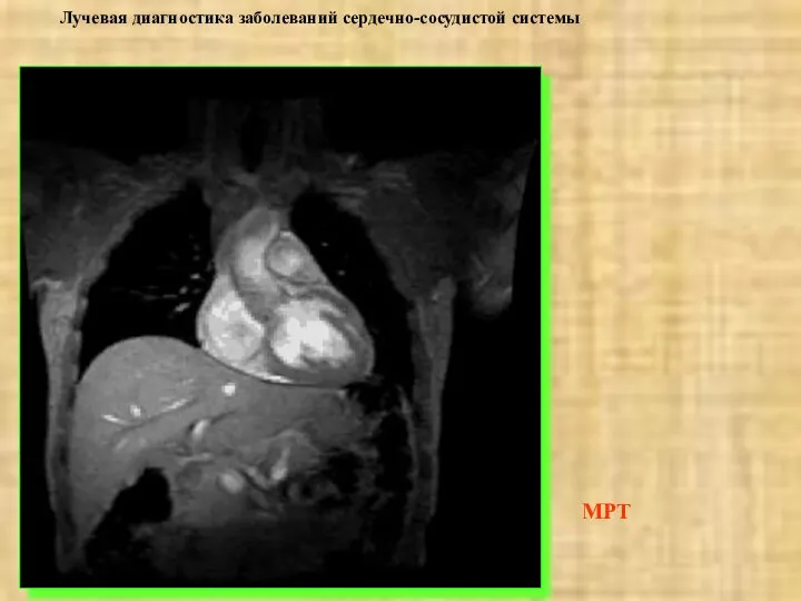 Лучевая диагностика заболеваний сердечно-сосудистой системы МРТ