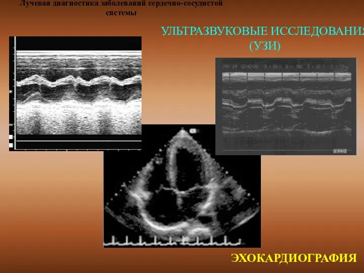 Лучевая диагностика заболеваний сердечно-сосудистой системы УЛЬТРАЗВУКОВЫЕ ИССЛЕДОВАНИЯ (УЗИ) ЭХОКАРДИОГРАФИЯ