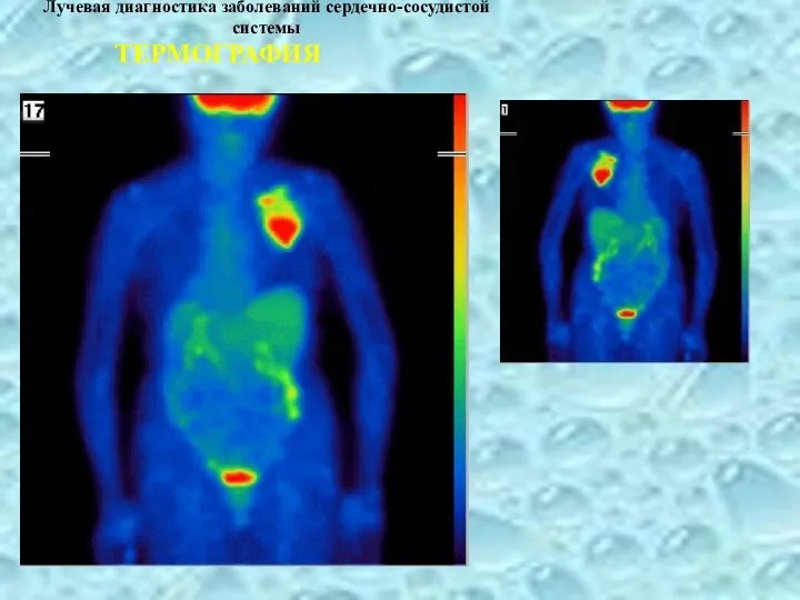 Лучевая диагностика заболеваний сердечно-сосудистой системы ТЕРМОГРАФИЯ
