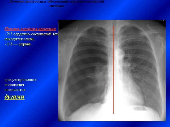 Лучевая диагностика заболеваний сердечно-сосудистой системы краєутворюющие положения називаются дугами Прямая передняя