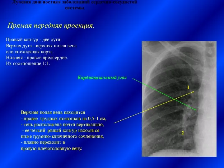 Лучевая диагностика заболеваний сердечно-сосудистой системы Правый контур - две дуги. Верхня