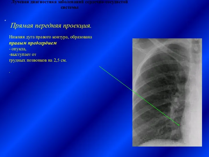 Лучевая диагностика заболеваний сердечно-сосудистой системы Нижняя дуга правого контура, образована правым