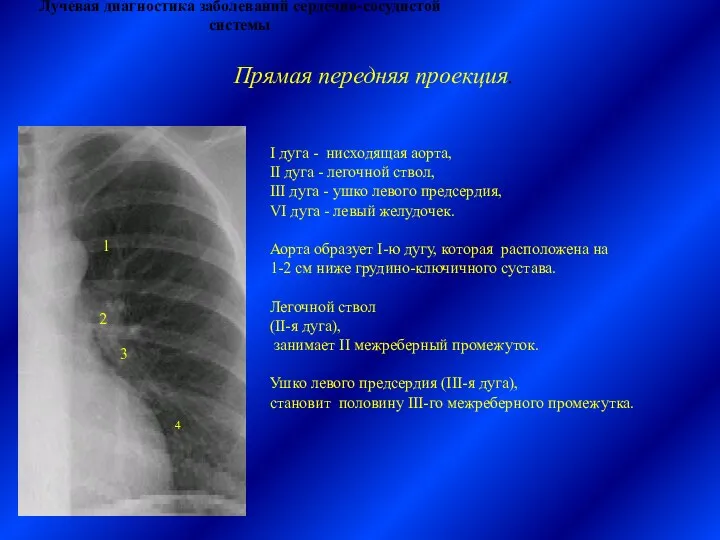 Лучевая диагностика заболеваний сердечно-сосудистой системы І дуга - нисходящая аорта, ІІ