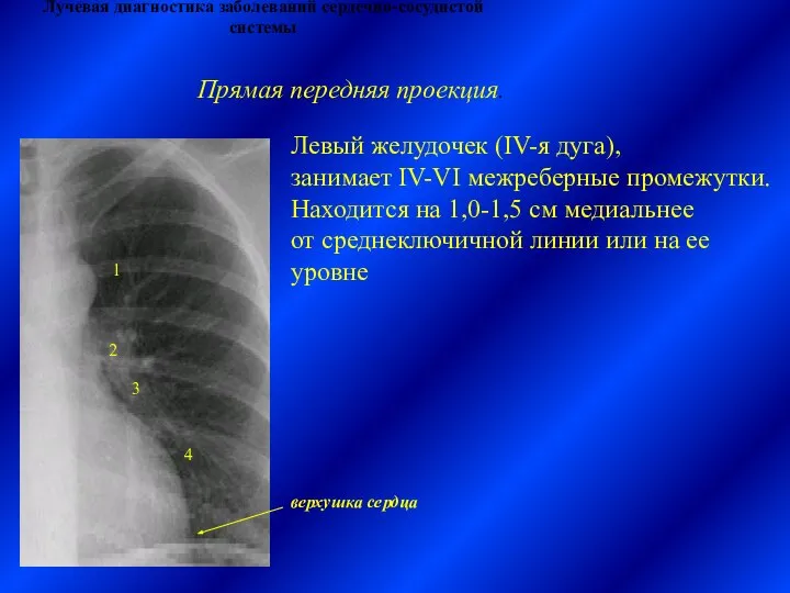 Лучевая диагностика заболеваний сердечно-сосудистой системы Левый желудочек (IV-я дуга), занимает IV-VI