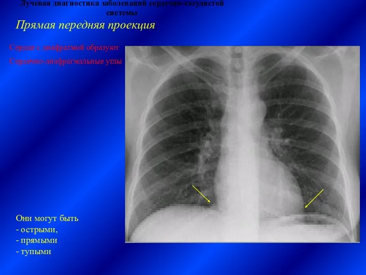 Лучевая диагностика заболеваний сердечно-сосудистой системы Прямая передняя проекция. Сердце с диафрагмой