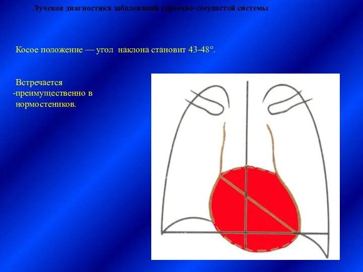 Лучевая диагностика заболеваний сердечно-сосудистой системы Косое положение — угол наклона становит 43-48°. Встречается преимущественно в нормостеников.