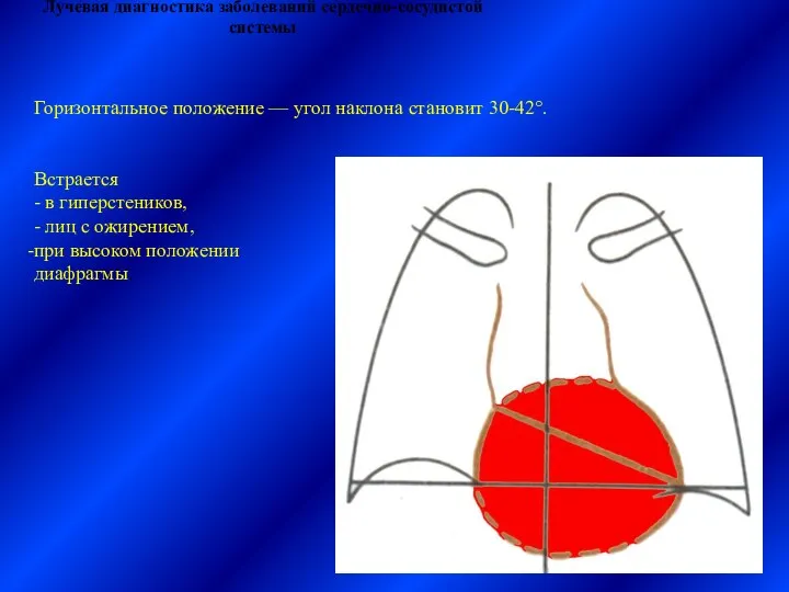 Лучевая диагностика заболеваний сердечно-сосудистой системы Горизонтальное положение — угол наклона становит