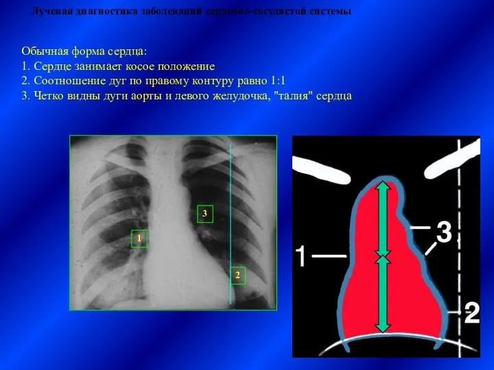 Лучевая диагностика заболеваний сердечно-сосудистой системы Обычная форма сердца: 1. Сердце занимает