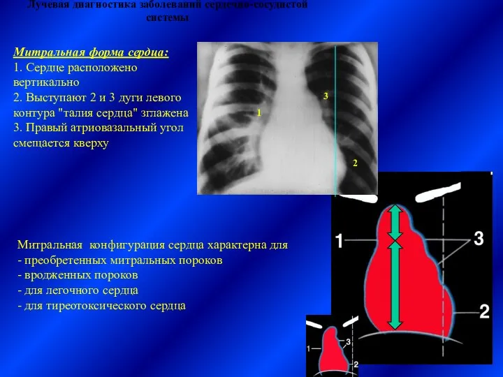 Лучевая диагностика заболеваний сердечно-сосудистой системы Митральная форма сердца: 1. Сердце расположено