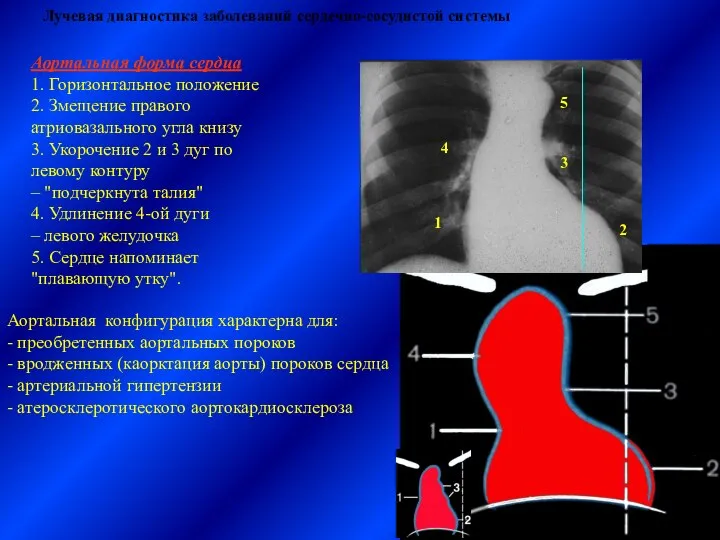 Лучевая диагностика заболеваний сердечно-сосудистой системы Аортальная форма сердца 1. Горизонтальное положение