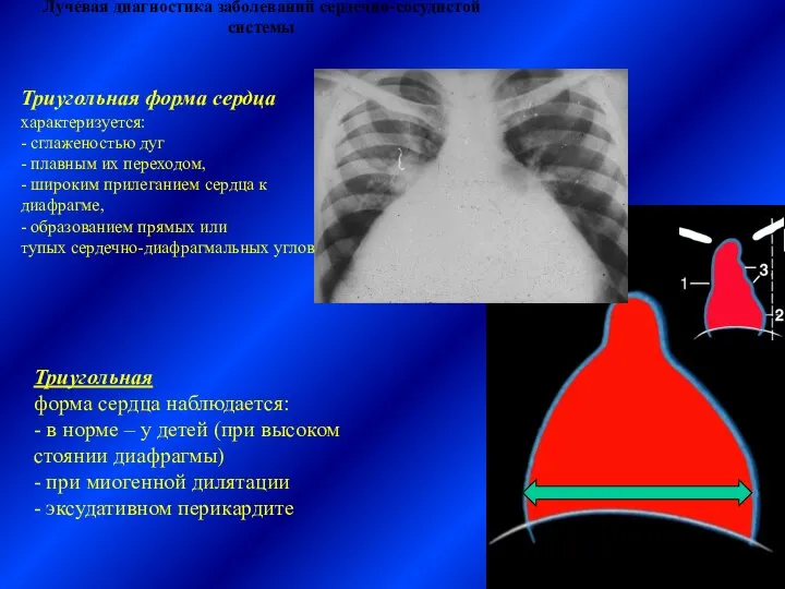 Лучевая диагностика заболеваний сердечно-сосудистой системы Триугольная форма сердца наблюдается: - в