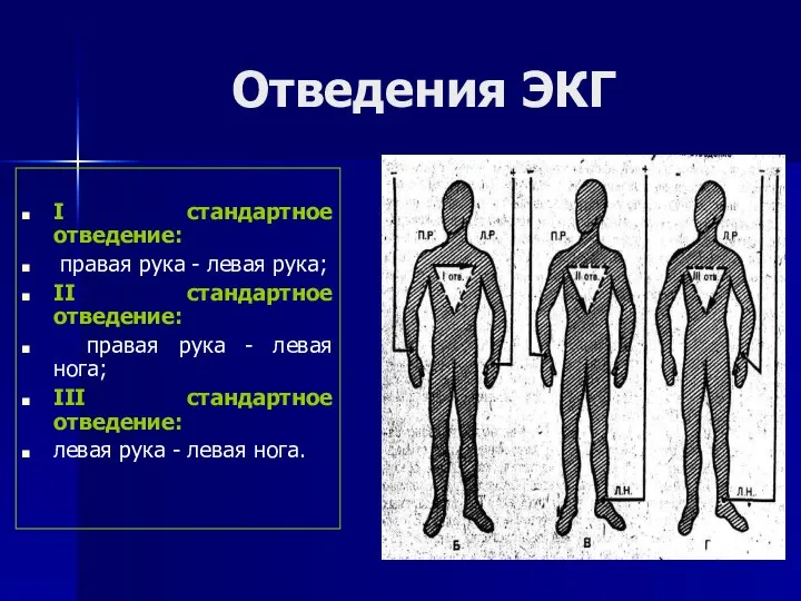 Отведения ЭКГ І стандартное отведение: правая рука - левая рука; ІІ