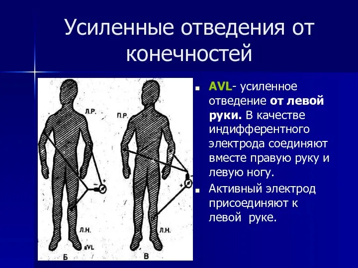 Усиленные отведения от конечностей АVL- усиленное отведение от левой руки. В