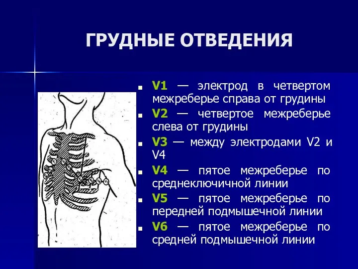 ГРУДНЫЕ ОТВЕДЕНИЯ V1 — электрод в четвертом межреберье справа от грудины