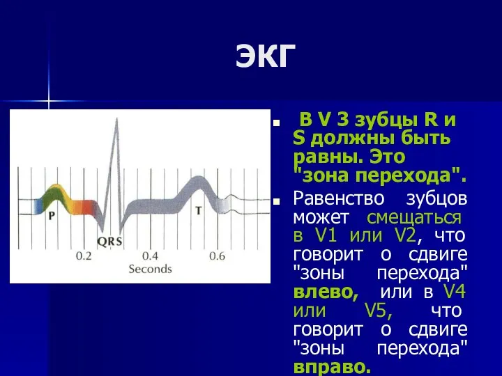 ЭКГ В V 3 зубцы R и S должны быть равны.