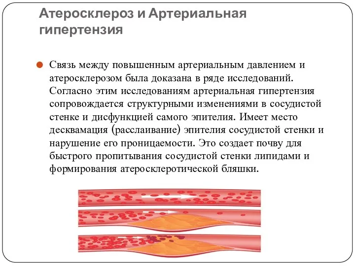 Атеросклероз и Артериальная гипертензия Связь между повышенным артериальным давлением и атеросклерозом