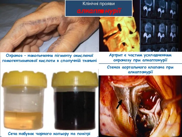 Сеча набуває чорного кольору на повітрі Клінічні прояви алкаптонурії Стеноз аортального
