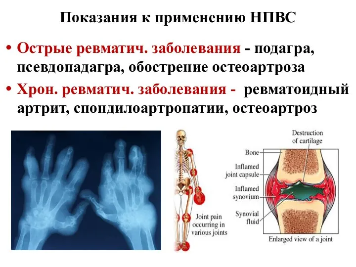 Показания к применению НПВС Острые ревматич. заболевания - подагра, псевдопадагра, обострение