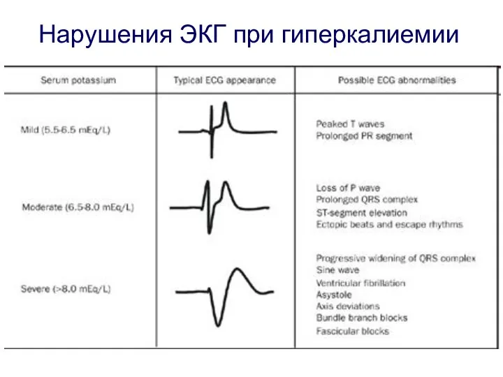 Нарушения ЭКГ при гиперкалиемии