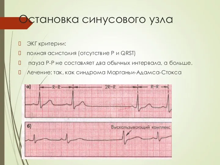 Остановка синусового узла ЭКГ критерии: полная асистолия (отсутствие Р и QRST)