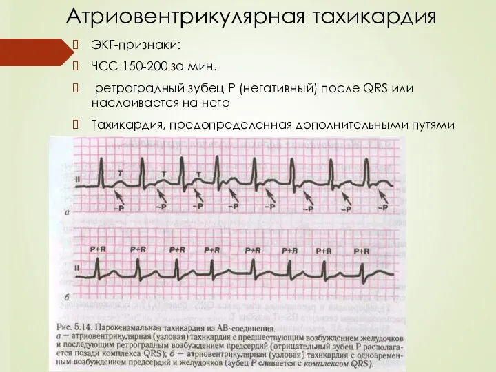 Атриовентрикулярная тахикардия ЭКГ-признаки: ЧСС 150-200 за мин. ретроградный зубец Р (негативный)