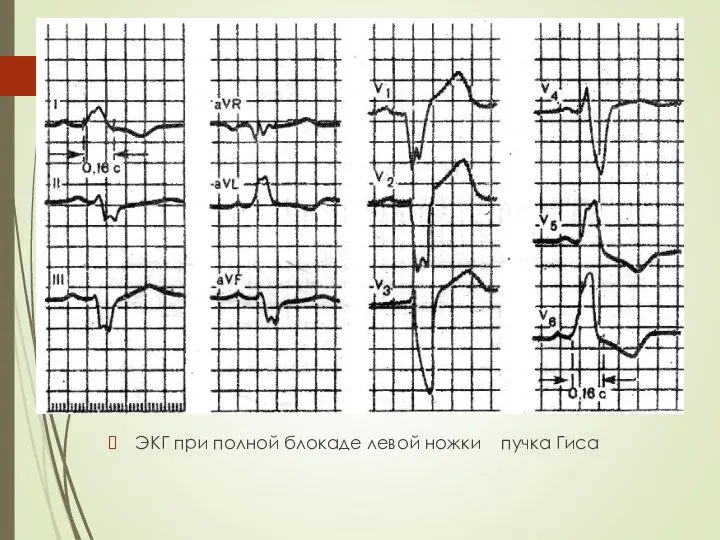 ЭКГ при полной блокаде левой ножки пучка Гиса
