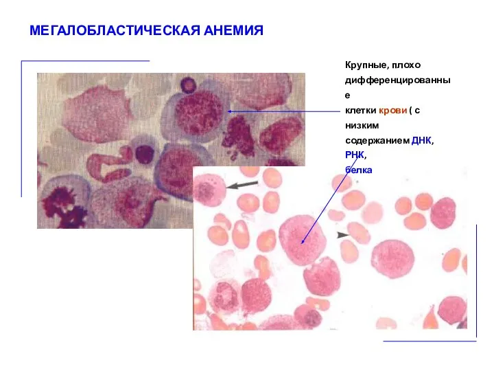 МЕГАЛОБЛАСТИЧЕСКАЯ АНЕМИЯ Крупные, плохо дифференцированные клетки крови ( с низким содержанием ДНК, РНК, белка